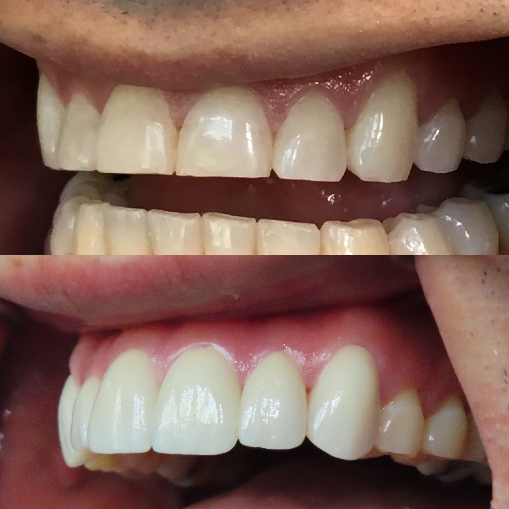 Veneers & Lumineers in Denver OG Dental 80211